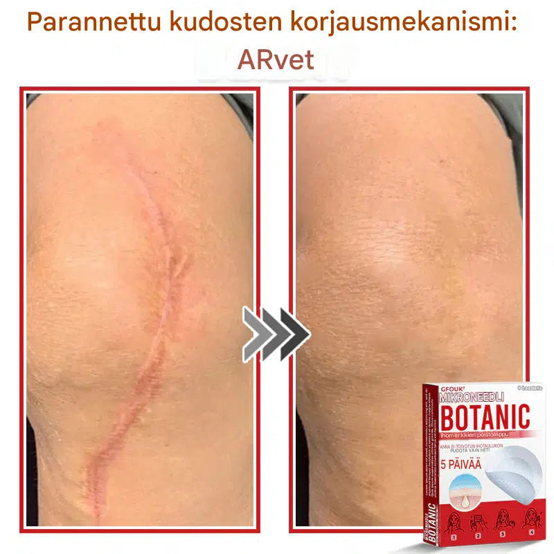 Kasvipohjaiset syylä- ja luomenpoistolaastarit