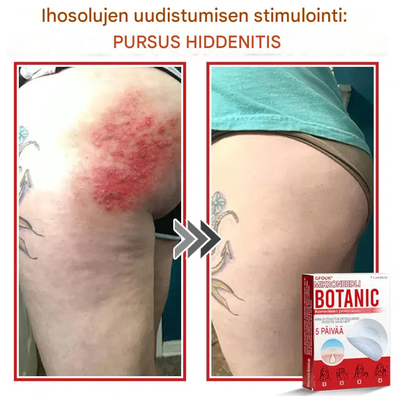 Kasvipohjaiset syylä- ja luomenpoistolaastarit