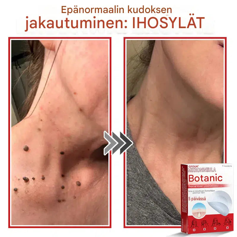 Kasvipohjaiset syylä- ja luomenpoistolaastarit
