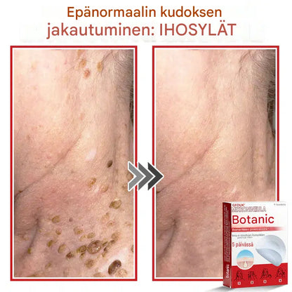 Kasvipohjaiset syylä- ja luomenpoistolaastarit