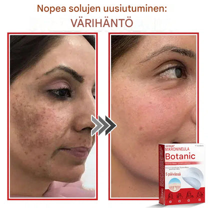 Kasvipohjaiset syylä- ja luomenpoistolaastarit