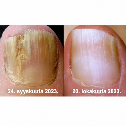 Mehiläisen Myrkky  - Kynsisienilääke: Kattava Ratkaisu Kynsisieniin