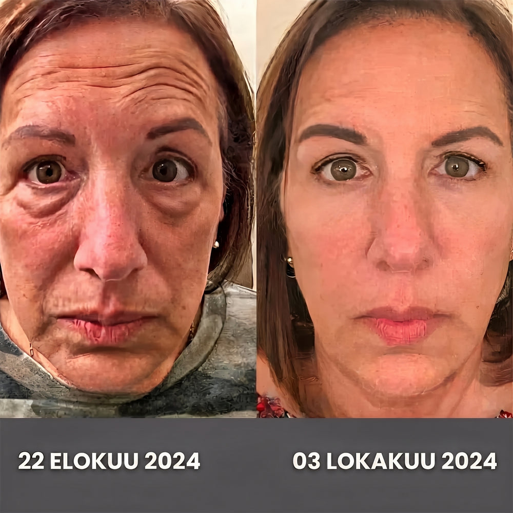 SÄÄSTÄ 500 € VUODESSA VÄLTTÄMÄLLÄ BOTOX-HOITOJA